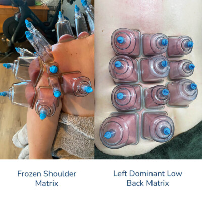 FasciaBuddySquared-FrozenShoulder-LowBack-1000-400x400